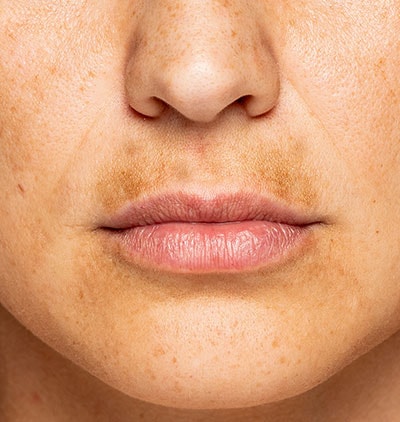 mulher de pele amarela com manchas na região do buço